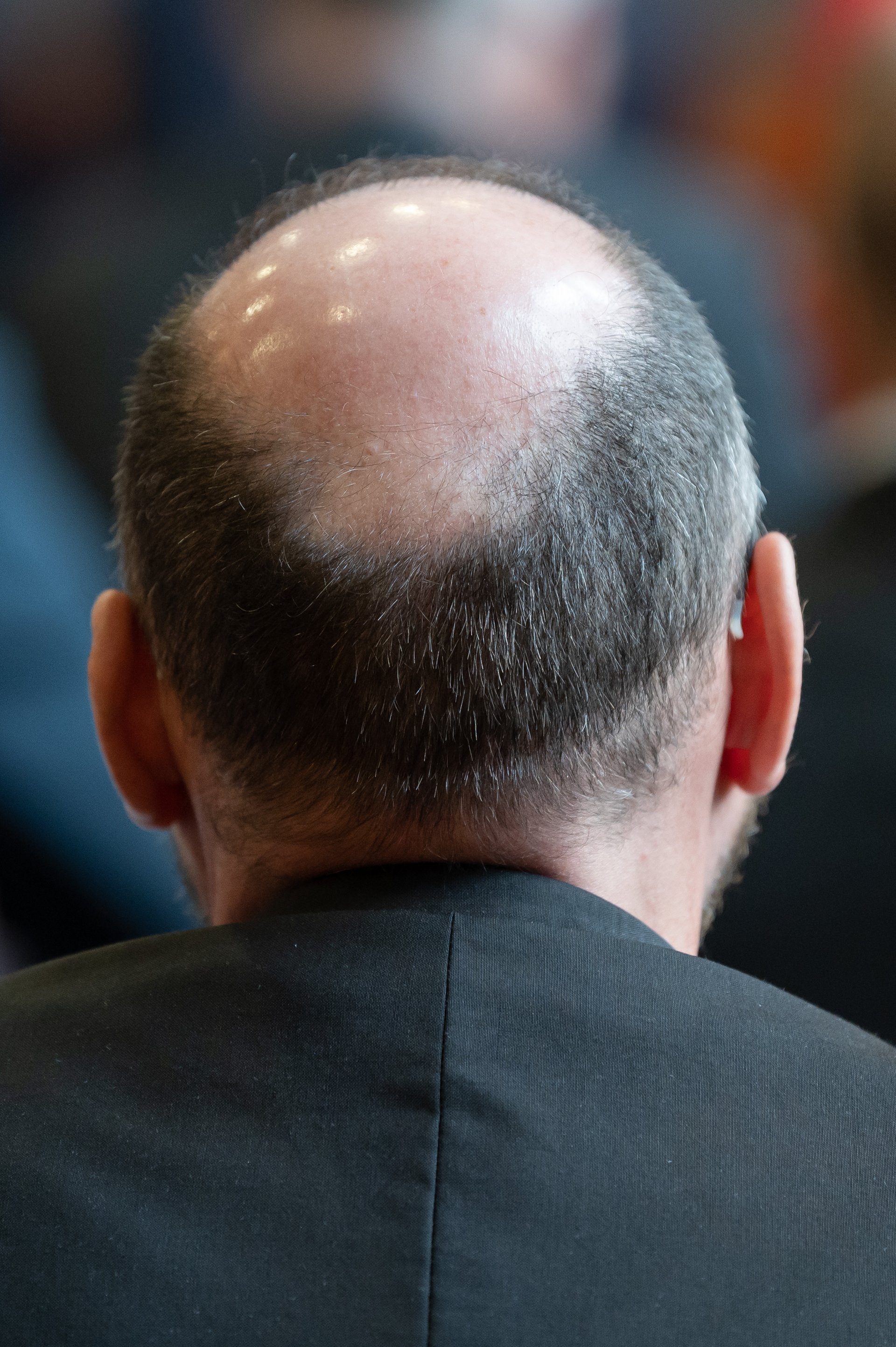 Veradermics déclare que sa pilule contre la perte de cheveux a passé une phase avancée d'essai, potentiellement le premier traitement oral approuvé en 30 ans.